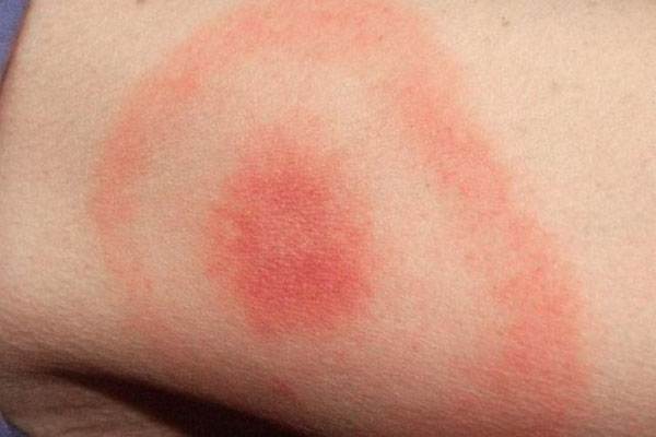 lyme_rash_3
