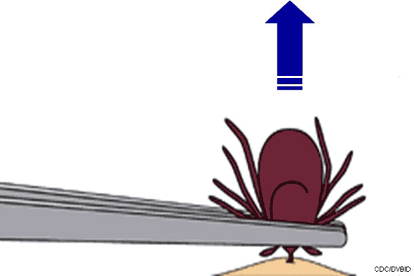 tick_remove_5